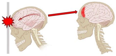 kronisk huvudvärk efter hjärnskakning